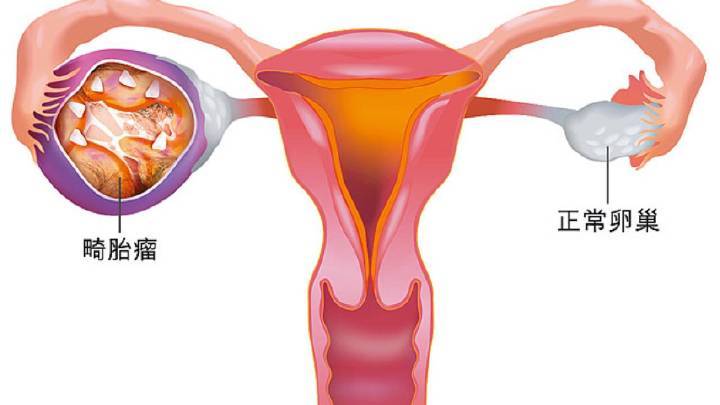 卵巢畸胎瘤.jpg
