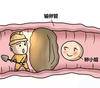 输卵管堵塞