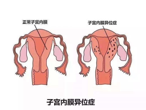 子宫内膜异位症怎么治疗