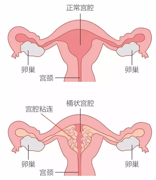 子宫粘连