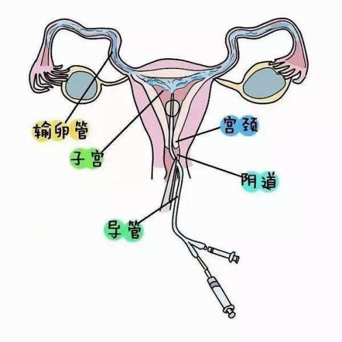 输卵管通水