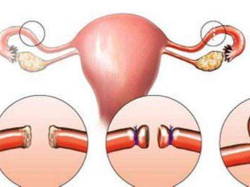 女性结扎，是通过输卵管结扎的方法