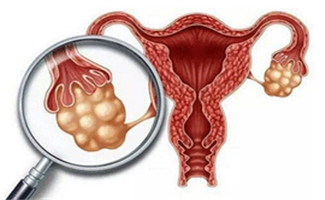 双侧卵巢均有巧囊，会不会影响泰国试管婴儿促排/取卵？