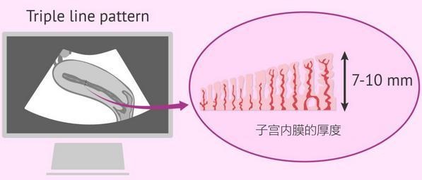 橄榄树生命——子宫内膜厚度