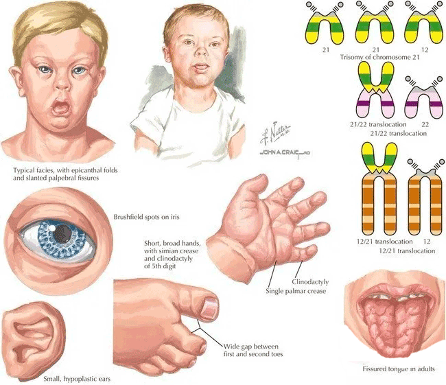 唐氏儿表现症状