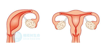 单角子宫女性做泰国试管婴儿，成功率有多少？