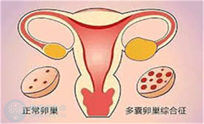 多囊卵子质量差，泰国试管婴儿的成功率高吗？