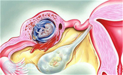试管婴儿胚胎移植后为什么会发生宫外孕？
