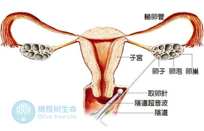 巧克力囊肿会引发哪些症状？该不该直接做试管婴儿？