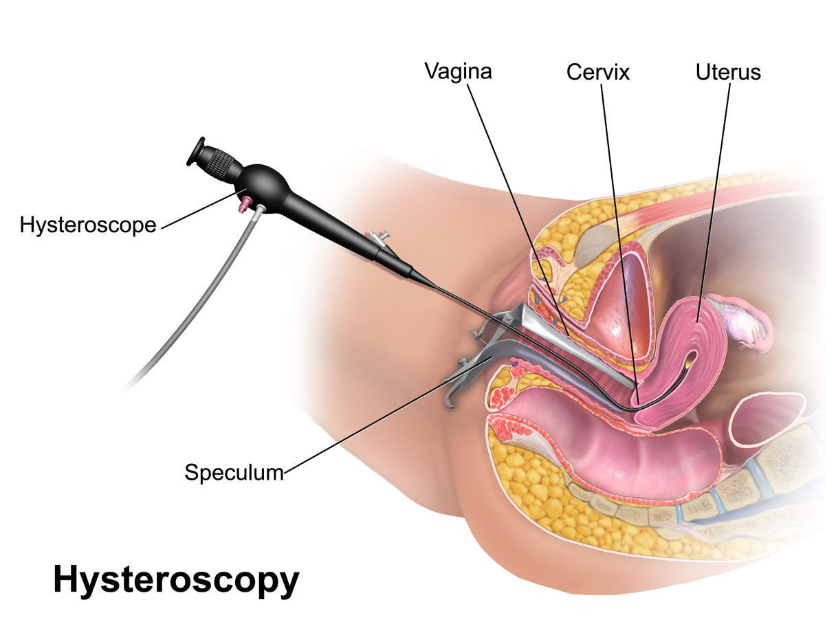 宫腔镜手术