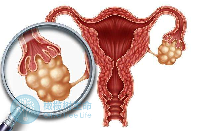 取卵后卵巢变大是怎么回事？如何调养助于卵巢恢复？