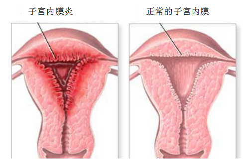 子宫内膜炎