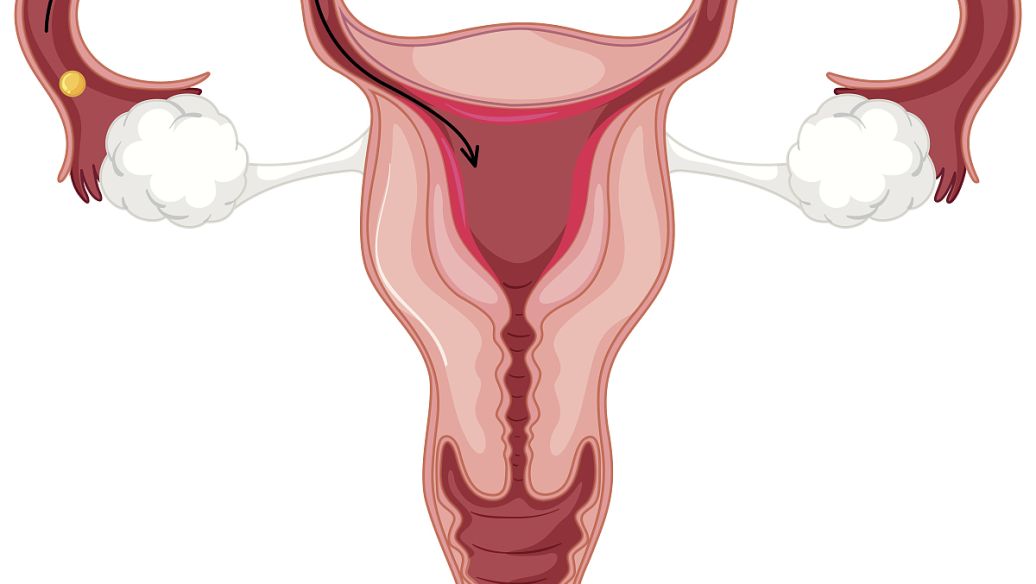 卵巢过度刺激综合征
