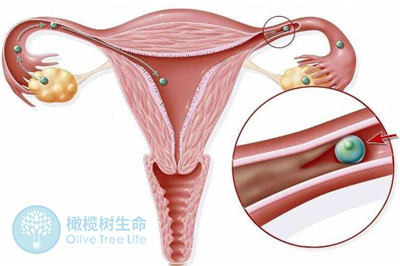 女性有子宫积液怎么办？做试管婴儿如何保障成功率？