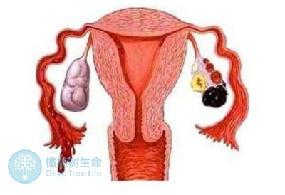 试管婴儿前检查出巧克力囊肿！试管流程该如何进行？