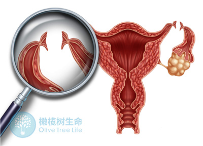 输卵管发育不良或功能异常，能做试管吗？