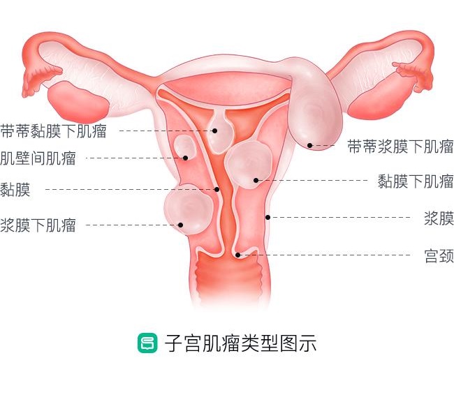 子宫肌瘤类型