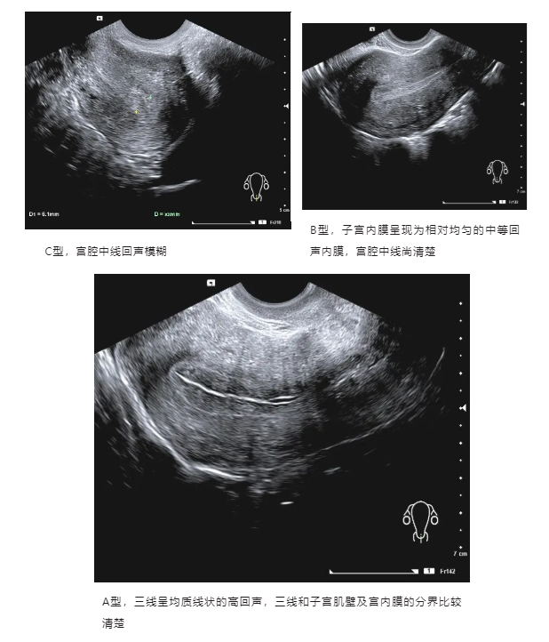 子宫内膜三线征