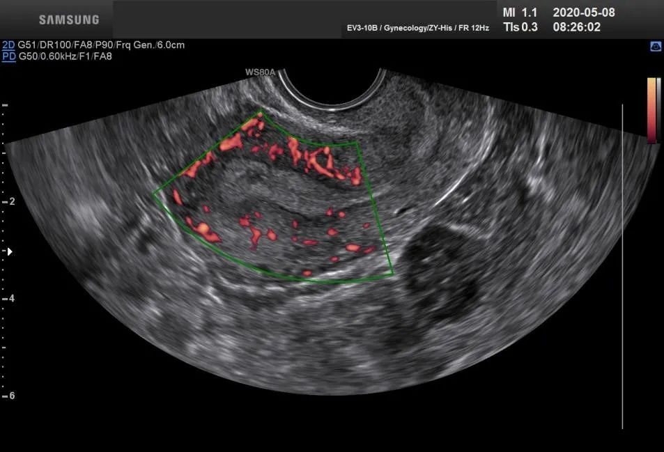 子宫内膜的血流