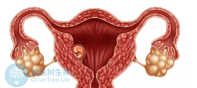 做试管婴儿一侧卵巢萎缩会影响排卵吗?