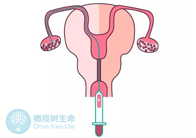 做试管婴儿，多个周期对卵巢有伤害吗？