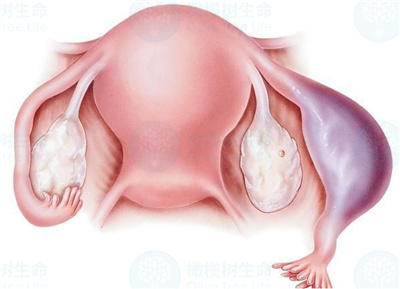 输卵管囊肿对做试管婴儿有影响吗？