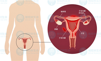 子宫内膜异位症你真的有吗？真的那么可怕吗？