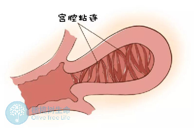 宫腔粘连能做试管婴儿吗，怀孕的几率高吗？