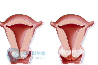 宫颈性疾病会引起不孕吗？做试管婴儿该如何解决？