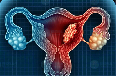 重度子宫内膜异位症做试管能否成功怀孕？
