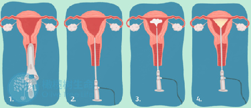 宫腔粘连做试管是否有影响，成功率高吗？