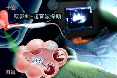 试管促排时遇到「空卵泡」，究竟是谁的错？