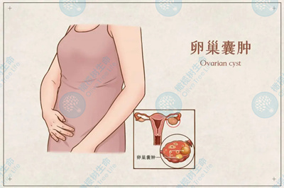 卵巢囊肿会不会影响卵泡发育？会影响试管周期吗？