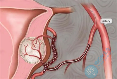 患有子宫肌瘤，会对试管婴儿移植造成影响吗？