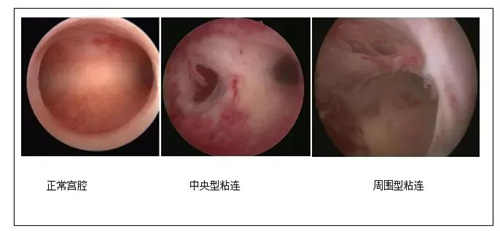 月经少？备孕难？小心这个好孕“绊脚石”