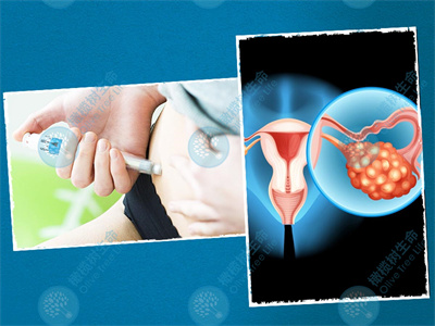 解惑：卵巢囊肿会影响试管婴儿成功率吗？