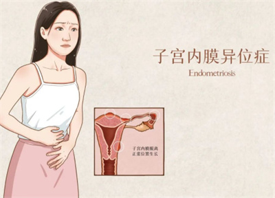 患有子宫内膜异位症，做试管婴儿的成功率高吗？