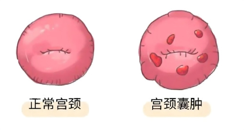 宫颈纳氏囊肿是什么？对试管婴儿周期有什么影响？
