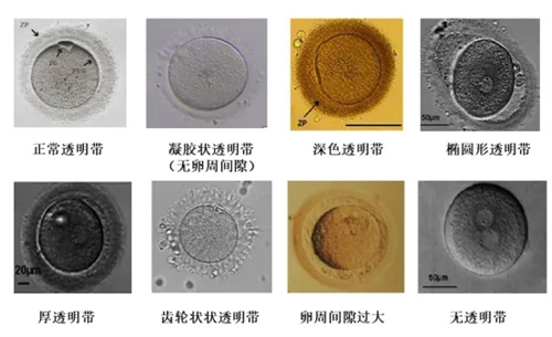 卵母细胞形态学异常对试管婴儿有什么影响？