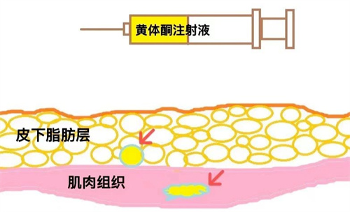 打黄体酮针后出现局部硬结，这些技巧可以避免！