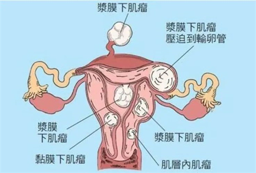 子宫内膜增厚与什么原因有关？该怎么防止内膜的增厚、恶变？