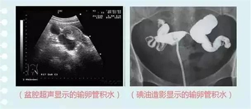 有优质胚胎也难怀上，这个因素最常见！