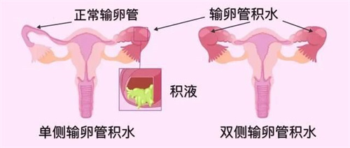 试管前发现输卵管积水，该选择哪种手术方式？