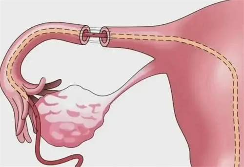试管前发现输卵管积水，该选择哪种手术方式？