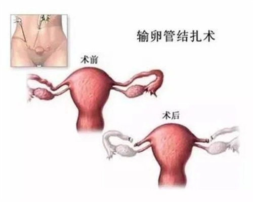 试管前发现输卵管积水，该选择哪种手术方式？