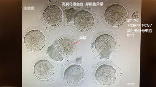 注意！这项指标异常也会影响你的好孕