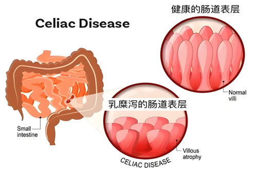 乳糜泻引发的不孕可以做试管婴儿解决吗？