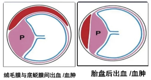 绒毛膜下出血是怎么回事？对怀孕有影响吗
