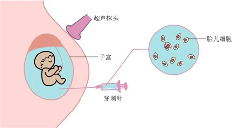 通过试管婴儿助孕做了PGT检测后，为什么还要做羊水穿刺？