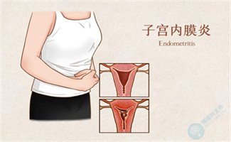 警惕慢性子宫内膜炎，别让好孕溜走！